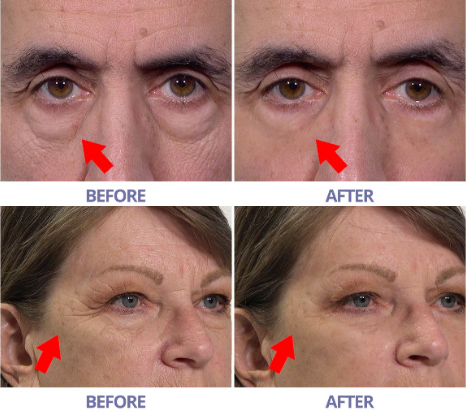 plexaderm before and after