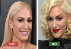 Gwen Stefani New Look (Plastic Surgery): What's The Secret?