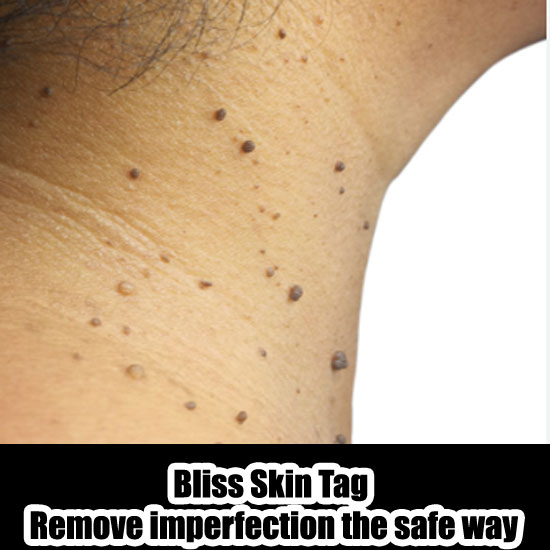 Bliss Skin Tag Remover1