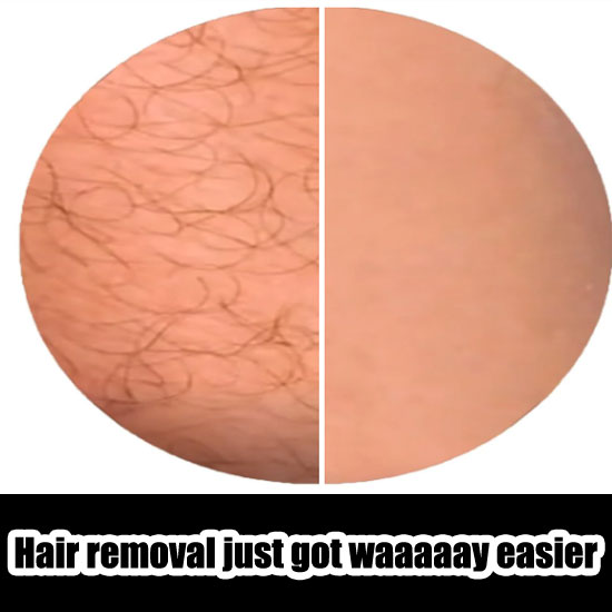5minskin Hair Removal Reviews - Must Read This Before Buying